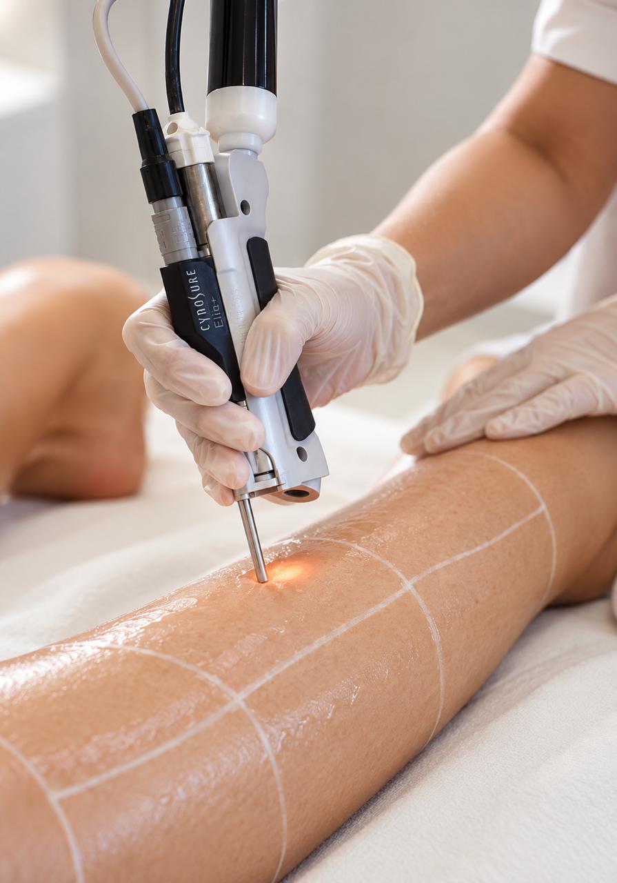 Laser hair removal treatment