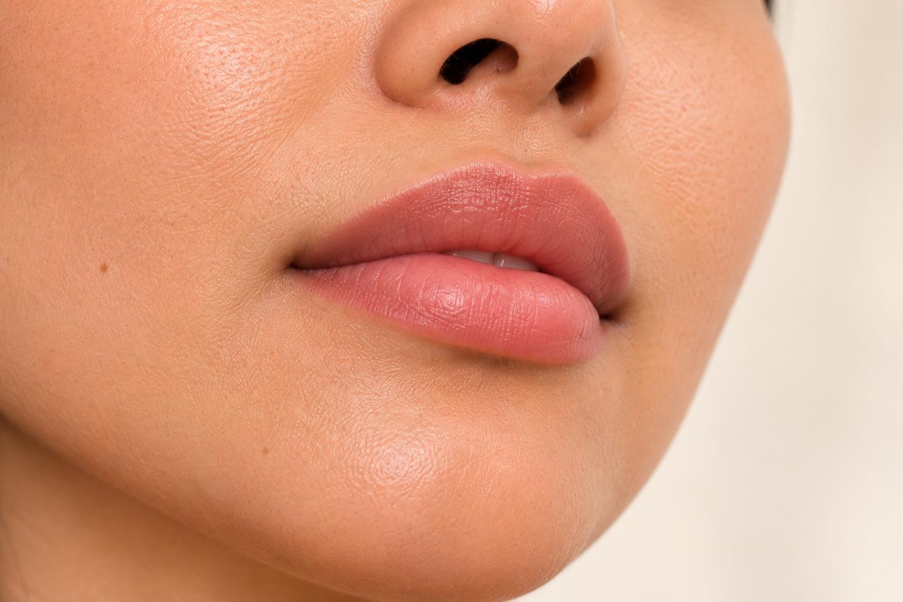 Dermal filler treatment