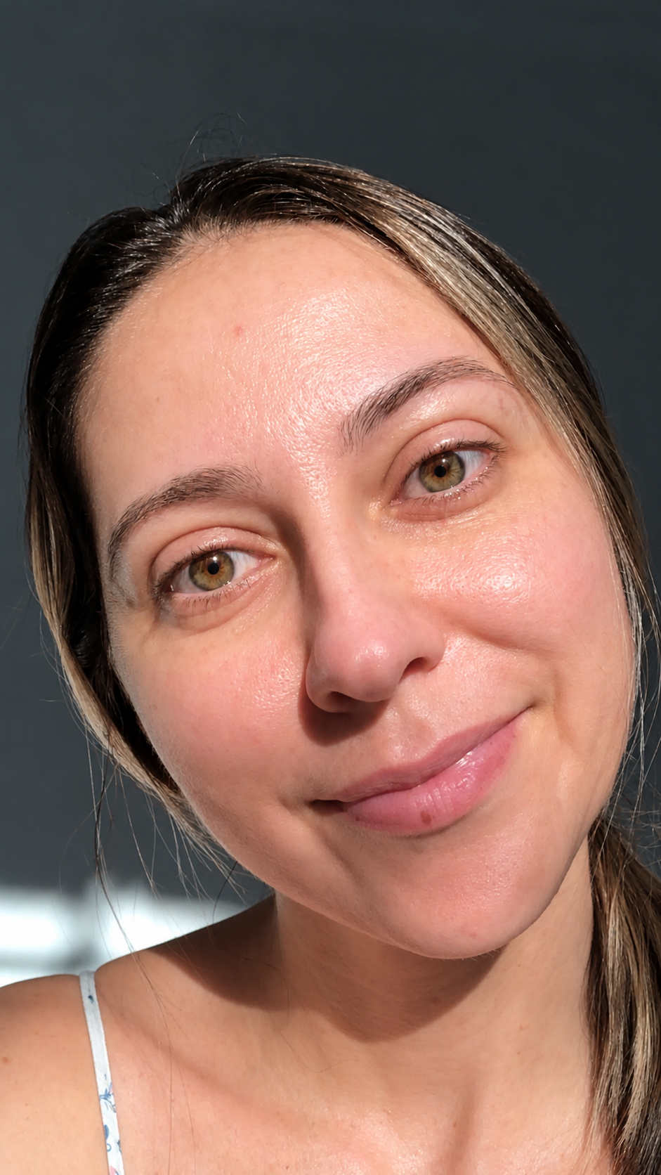 Tatiane's skin after managing melasma with the method
