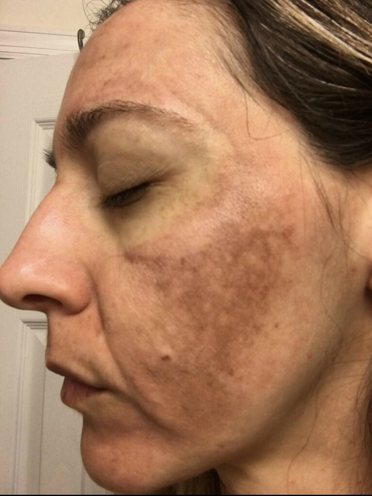 Tatiane's skin before following the protocol