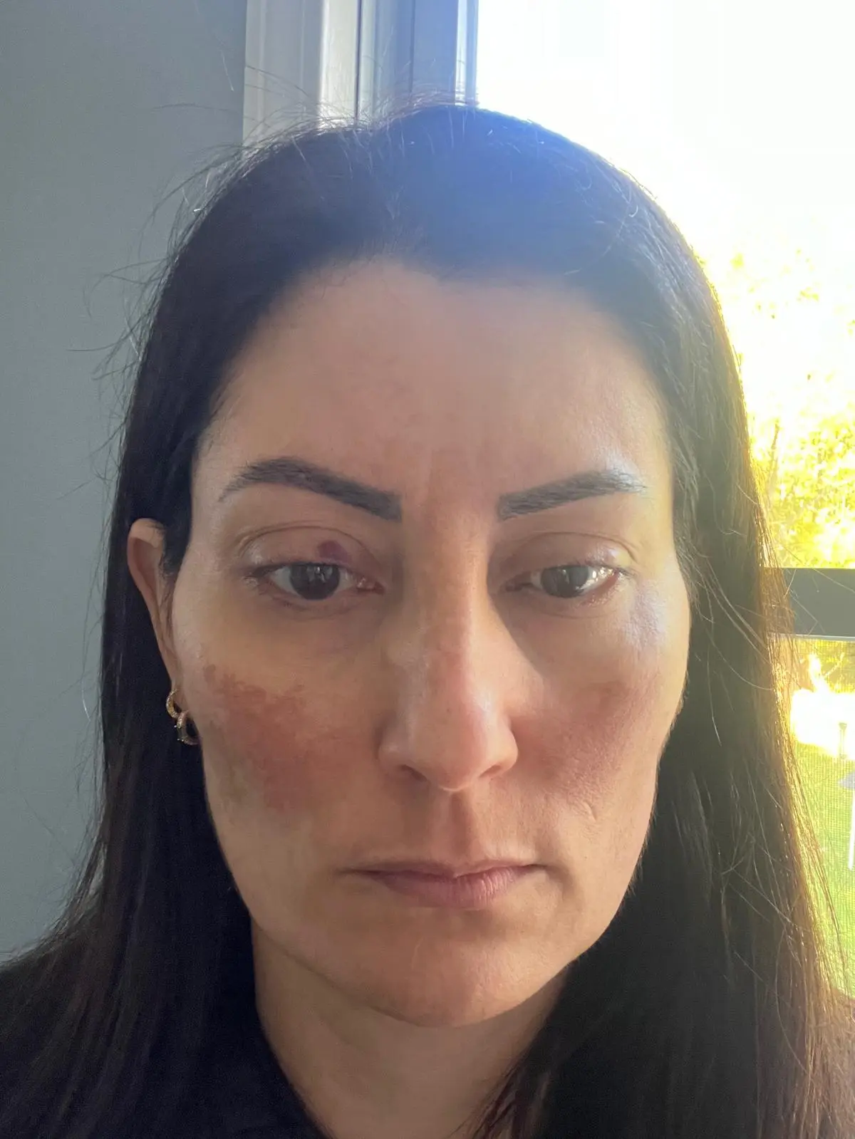 Fernanda — before