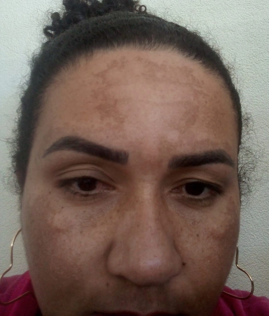 Teliana — before