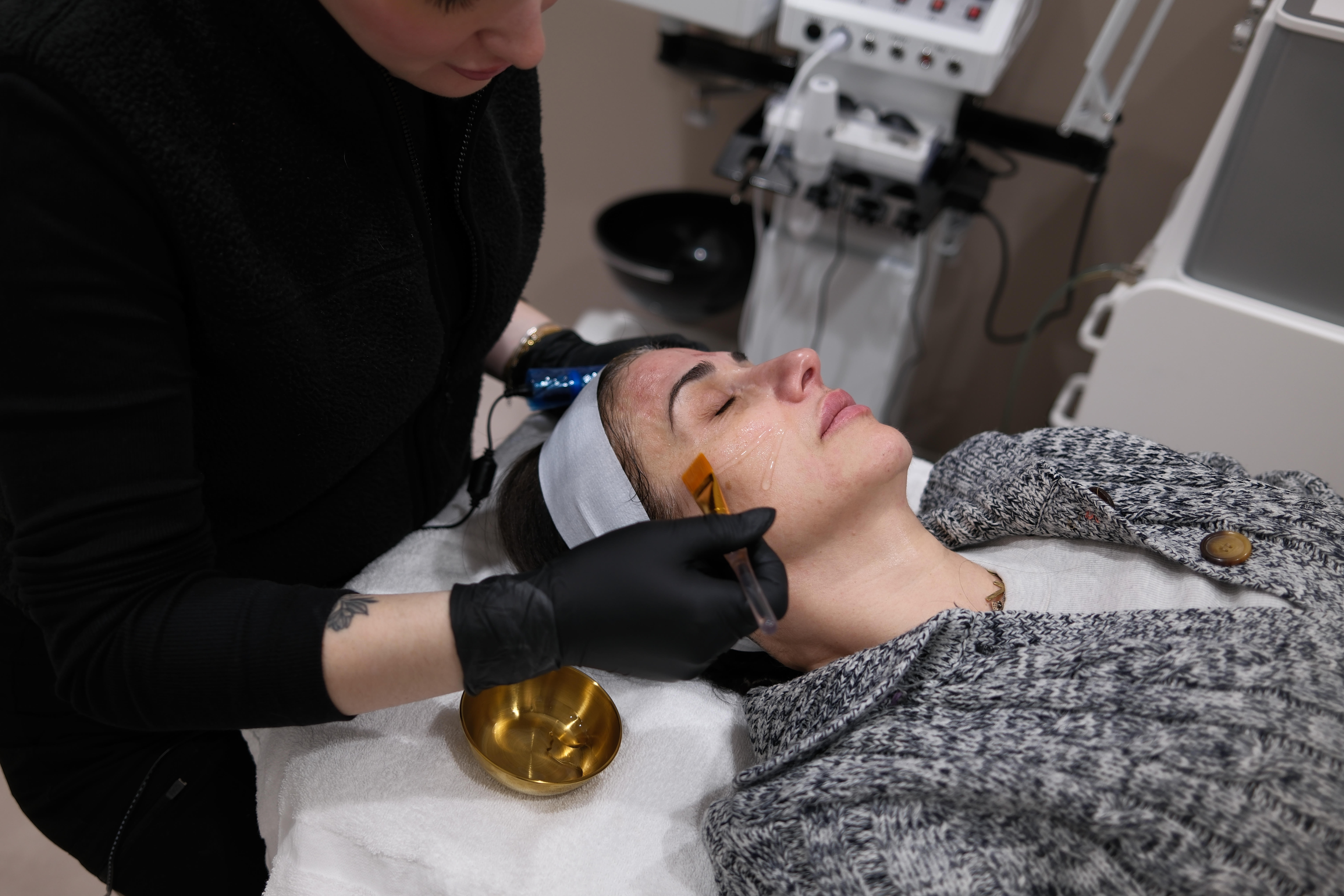 Microneedling skin treatment in Boston