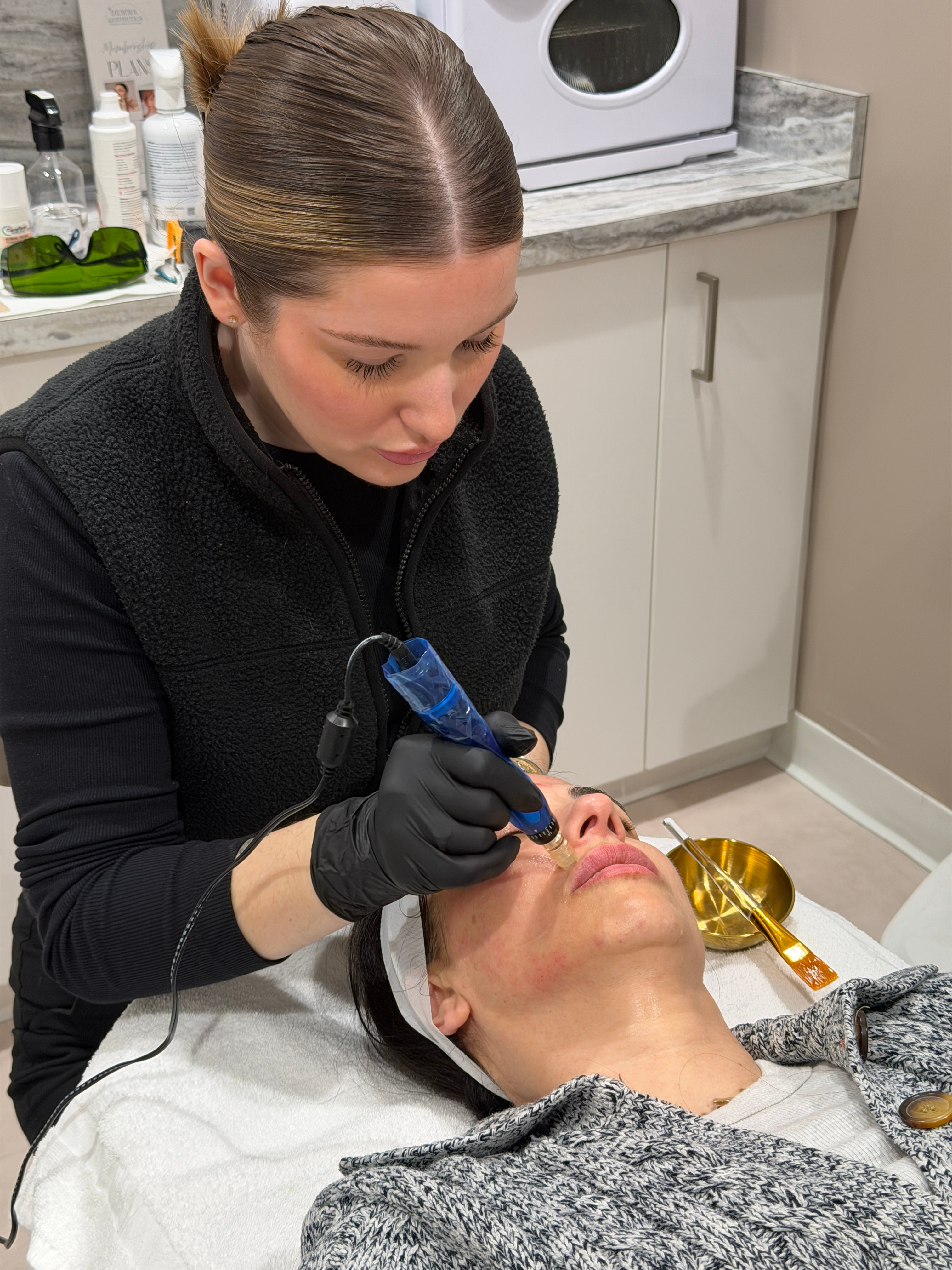 Microneedling treatment in progress