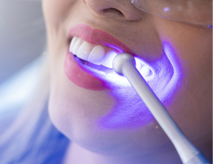 Teeth whitening treatment