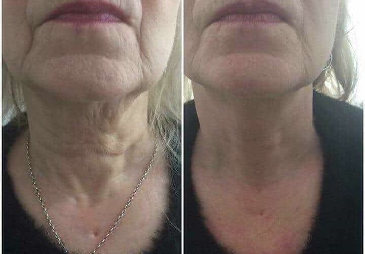 HIFU result client before and after