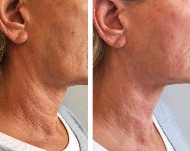 HIFU result client before and after