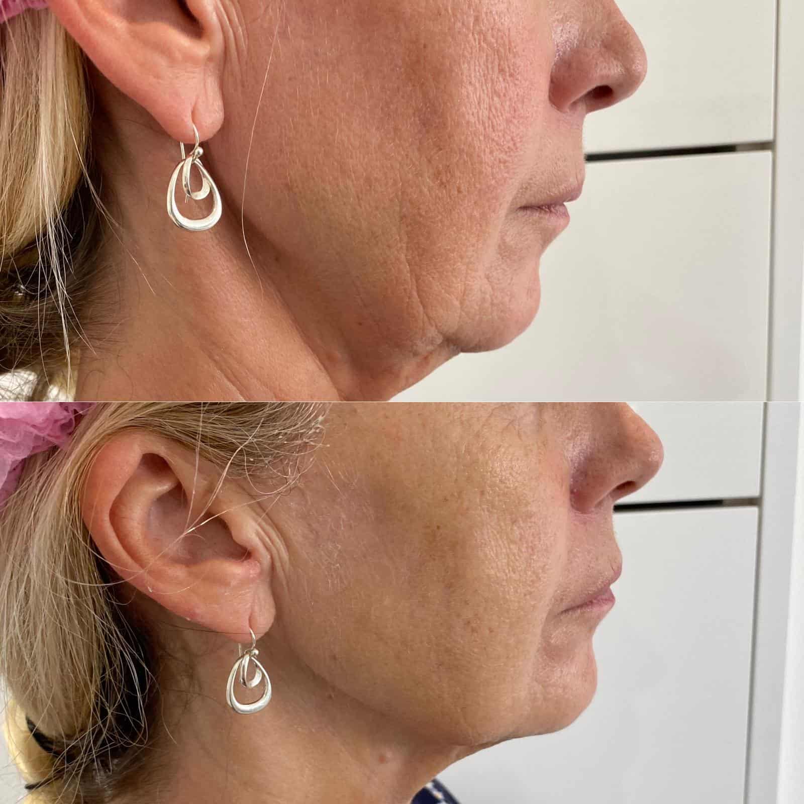 HIFU result client before and after