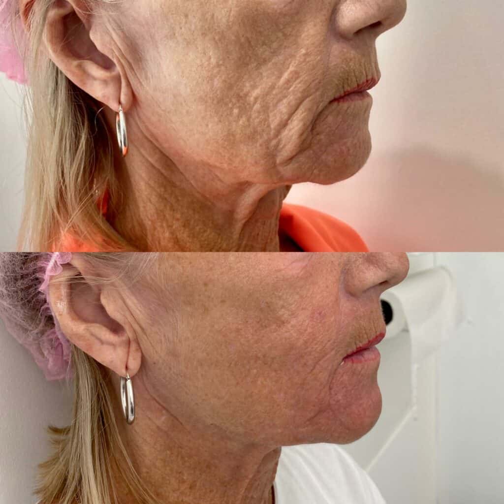 HIFU result client before and after