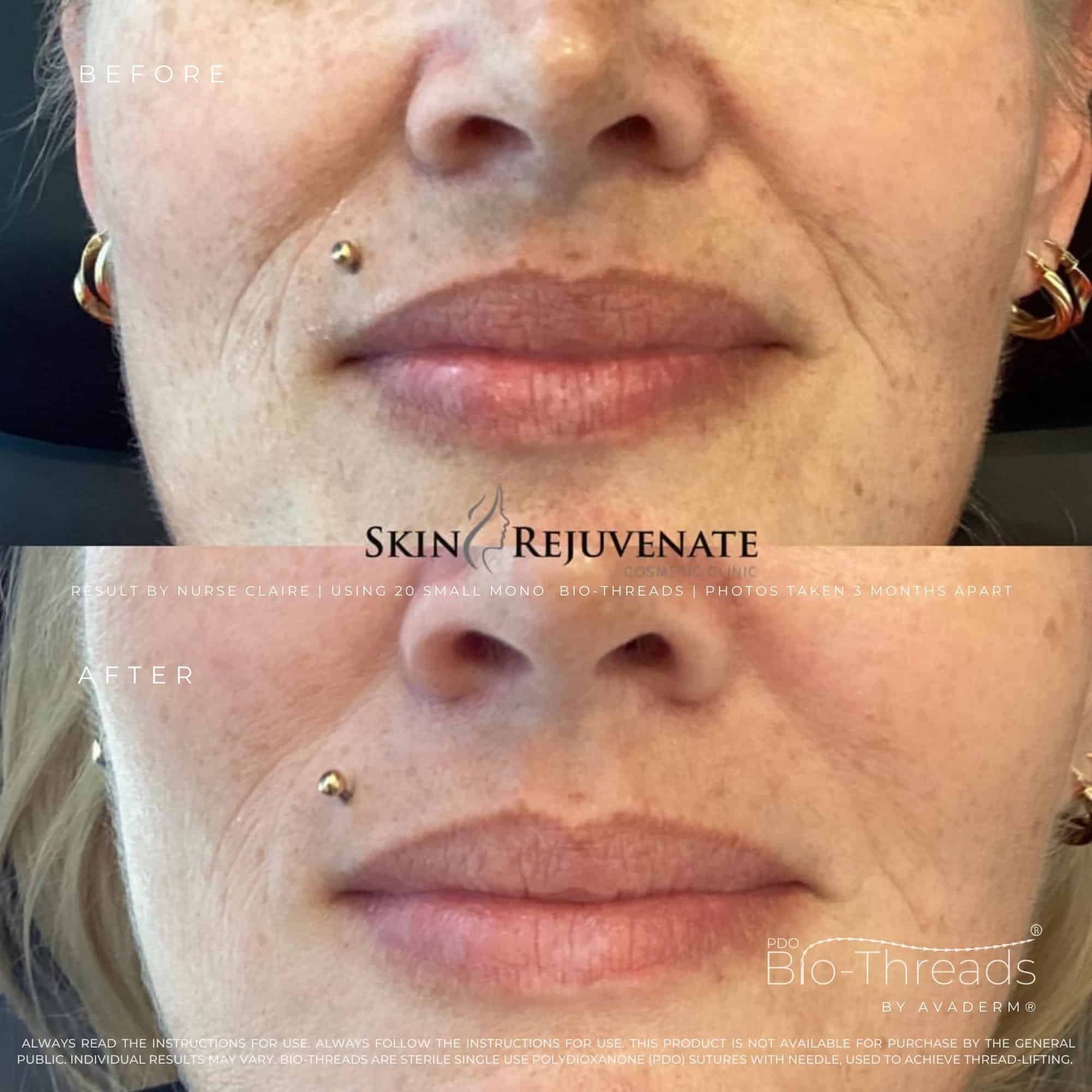 PDO thread lift result