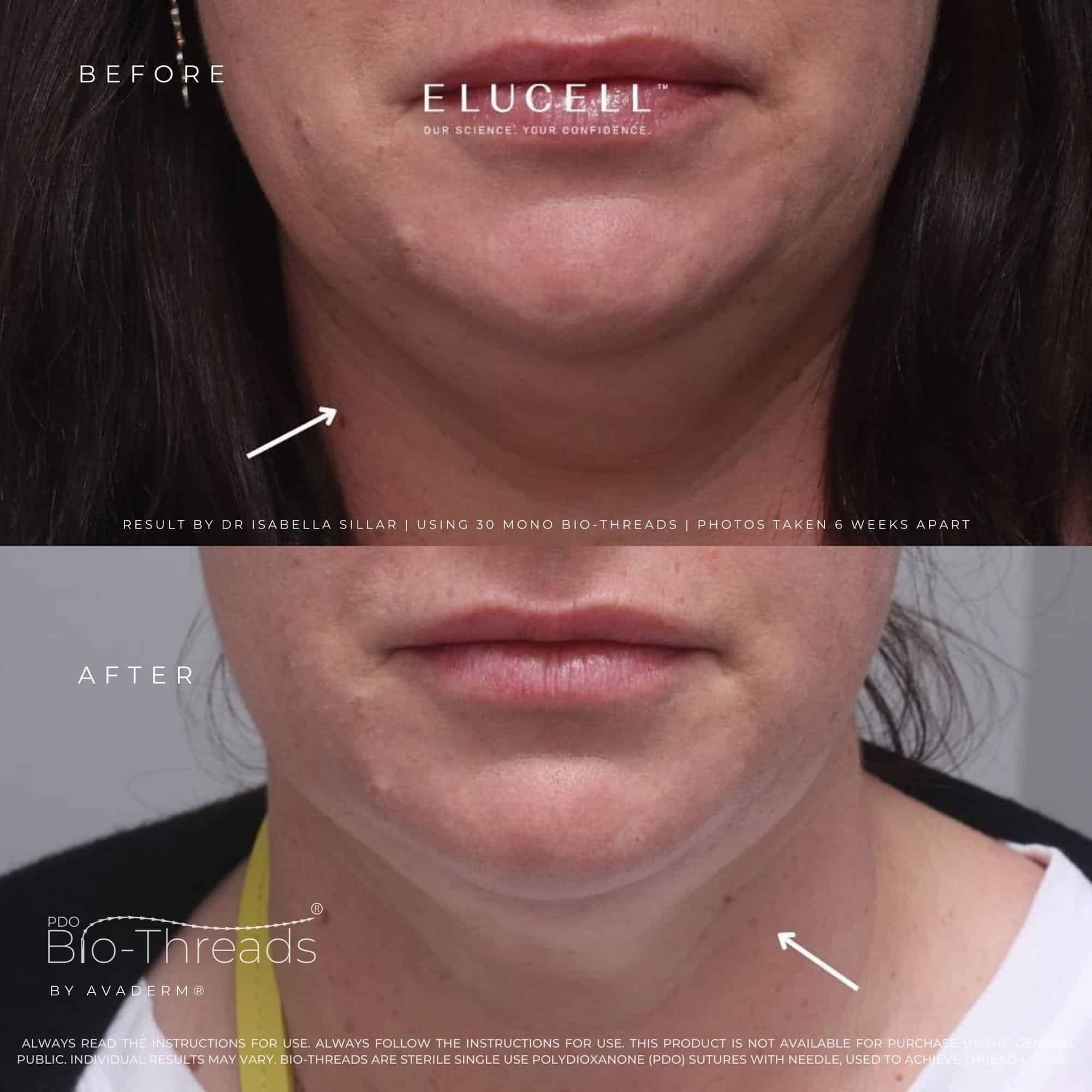 PDO thread lift result