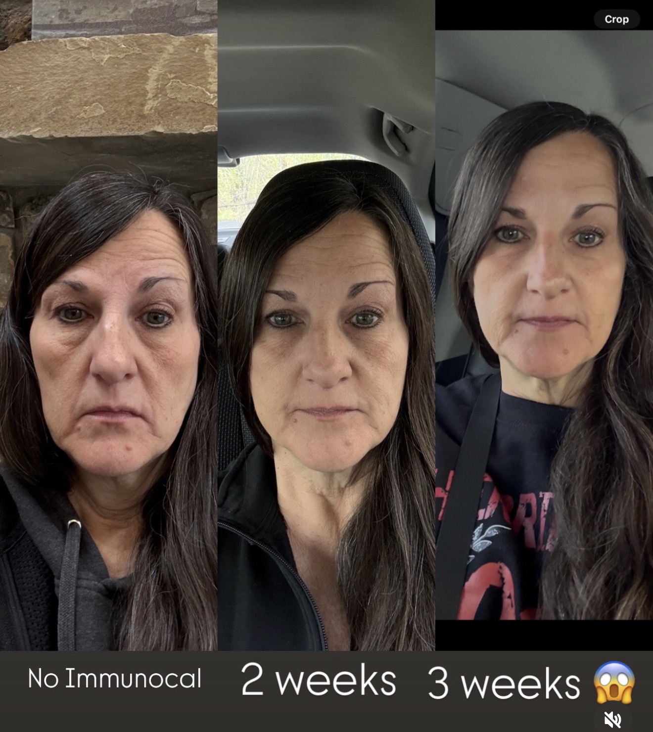 Before and after Immunocal results