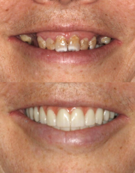 Smile Makeover All on Four