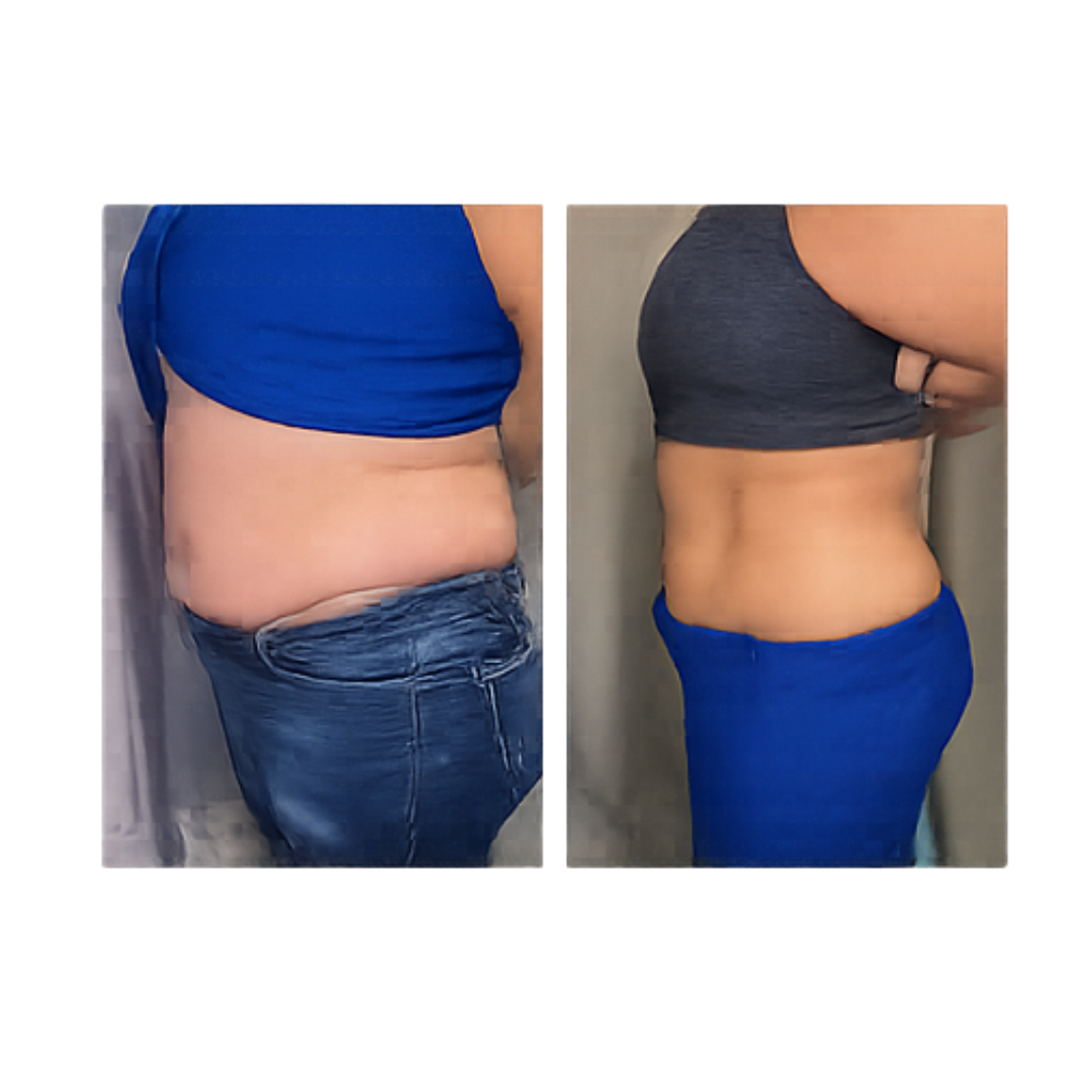 Cryo back and bra-line treatment before and after
