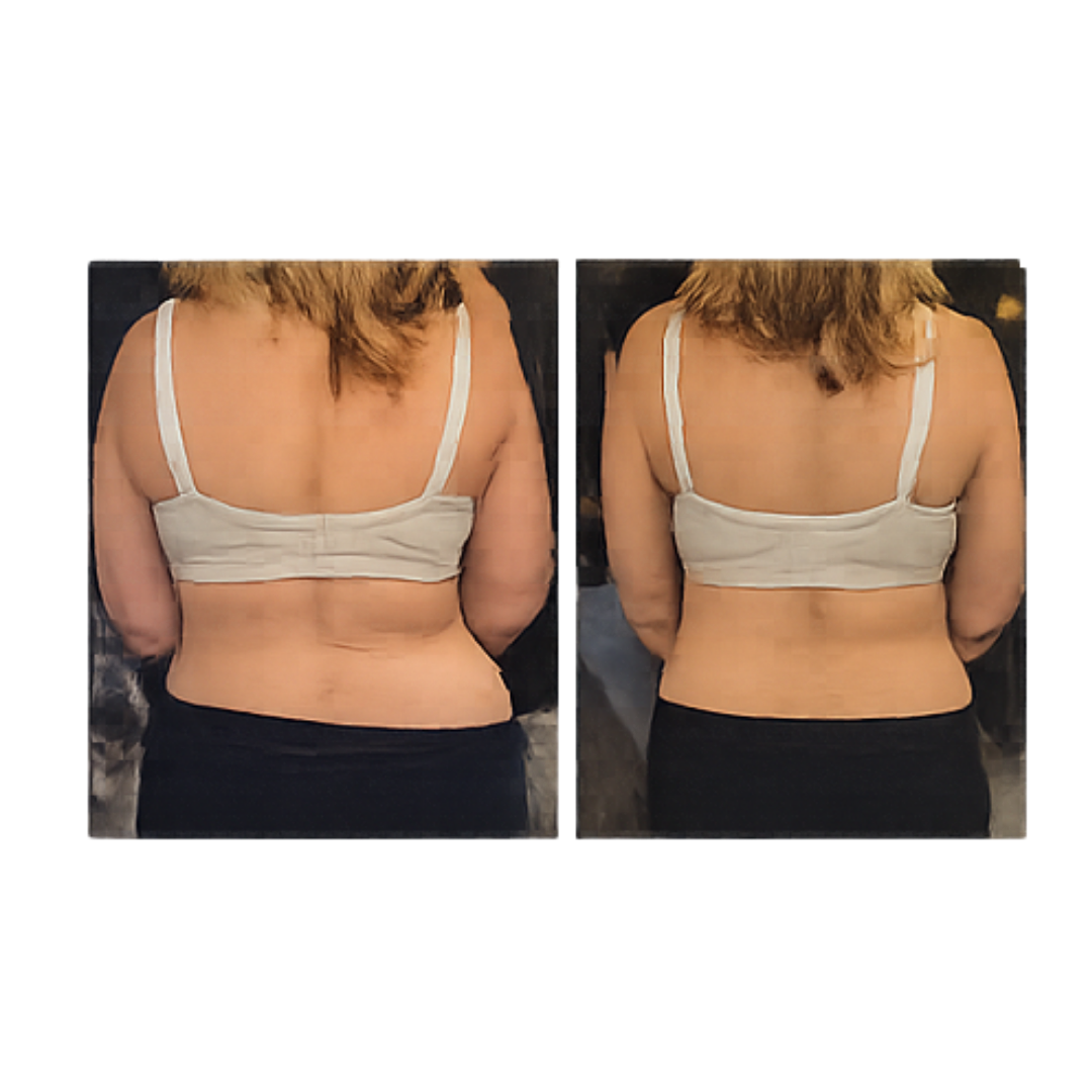 Cryo waist and stomach treatment before and after