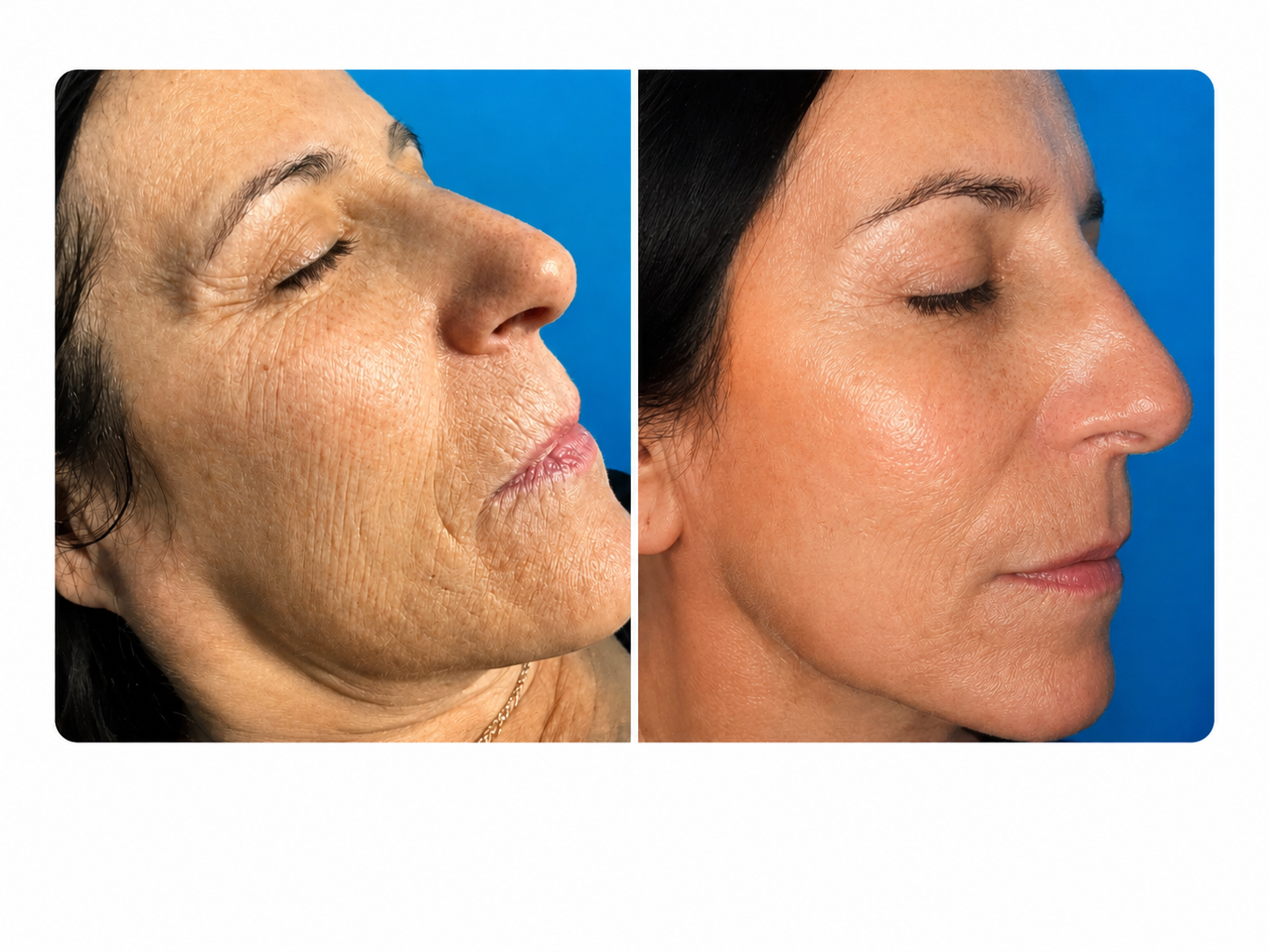 Cryo face treatment before and after