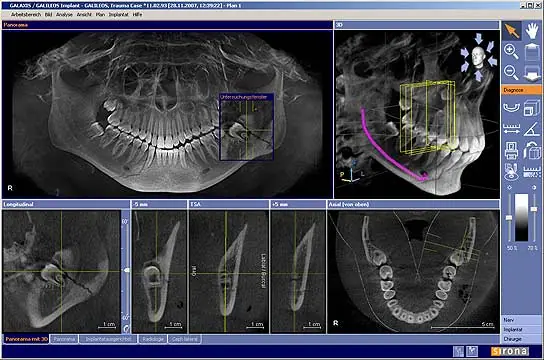 Cone-beam CT scan showing impacted wisdom teeth used for wisdom tooth removal planning at Park Family Dental in Cedar Park, TX