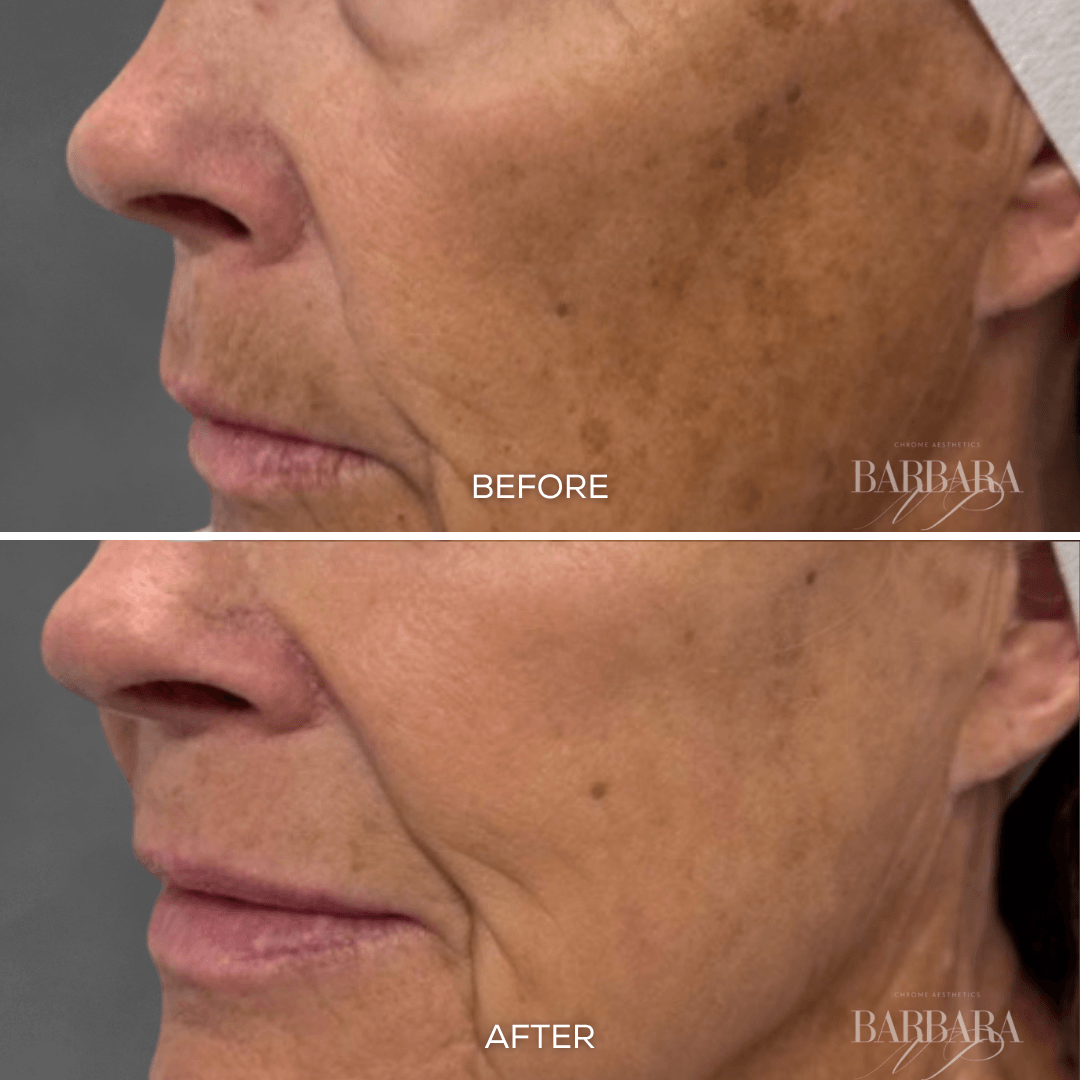 Before and after picture of a woman who got a BBL laser treatment on their face with significant less sunspots