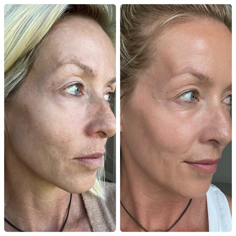 Before and after skincare result 2