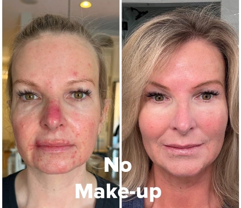 Before and after skincare result 4