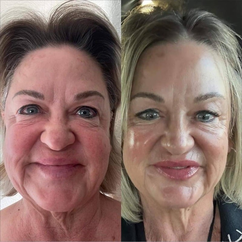 Before and after skincare result 5