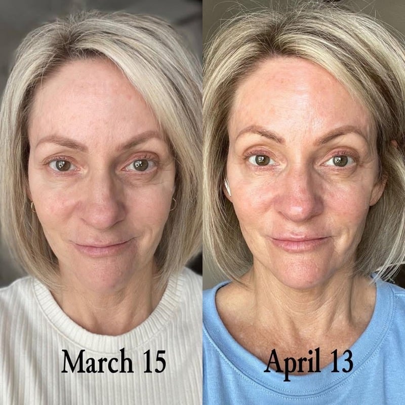 Before and after skincare result 10