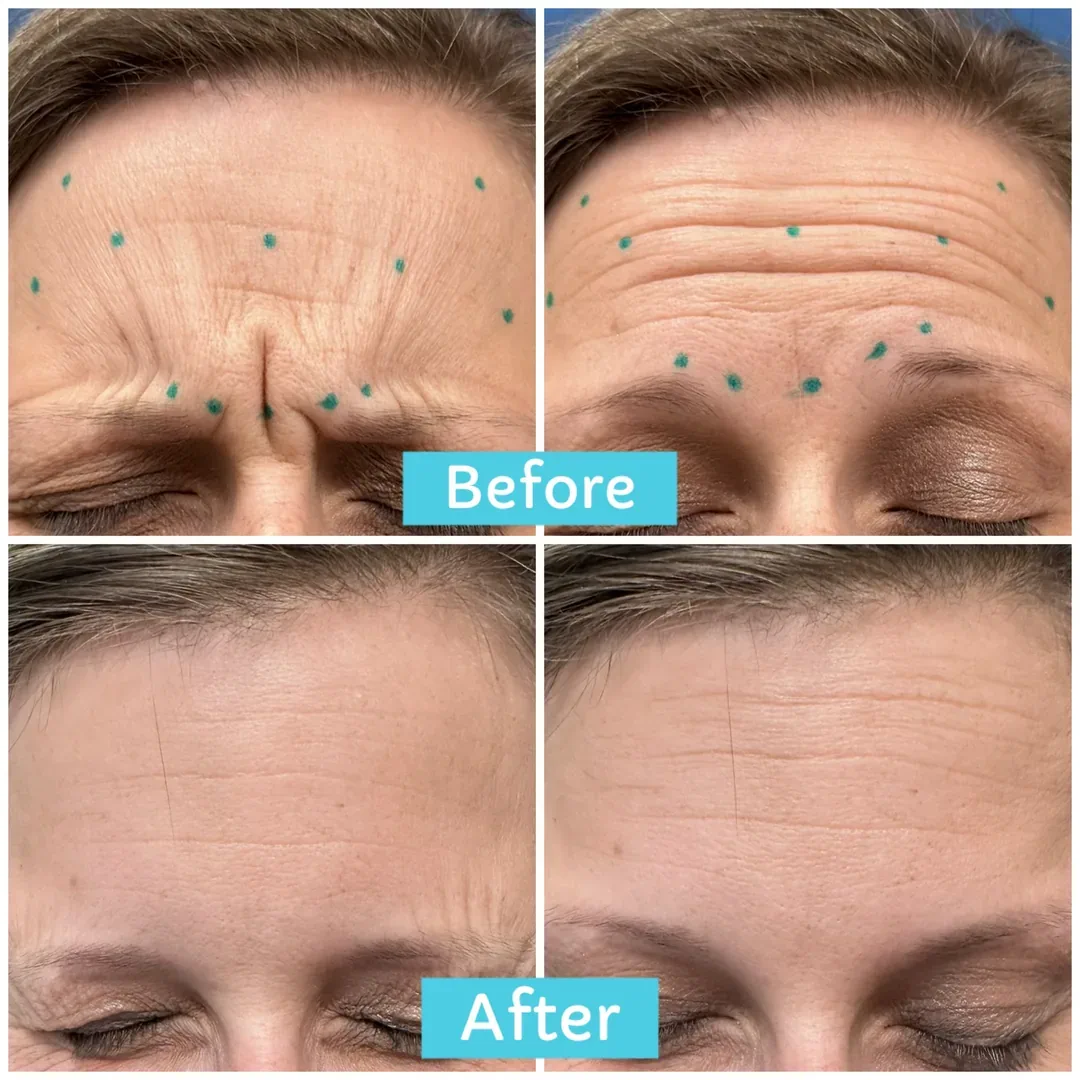 Before and after aesthetic results from Ablaze Aesthetics med spa Union KY