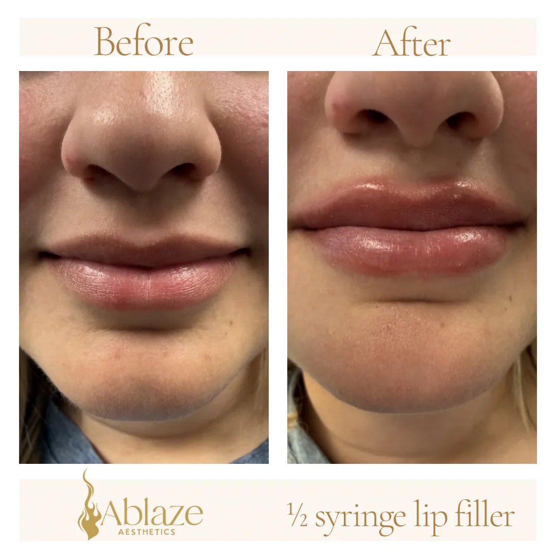 Ablaze Aesthetics before and after treatment result in Union KY