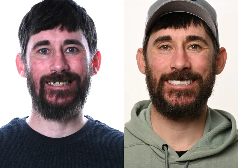 Before and after dental implant result