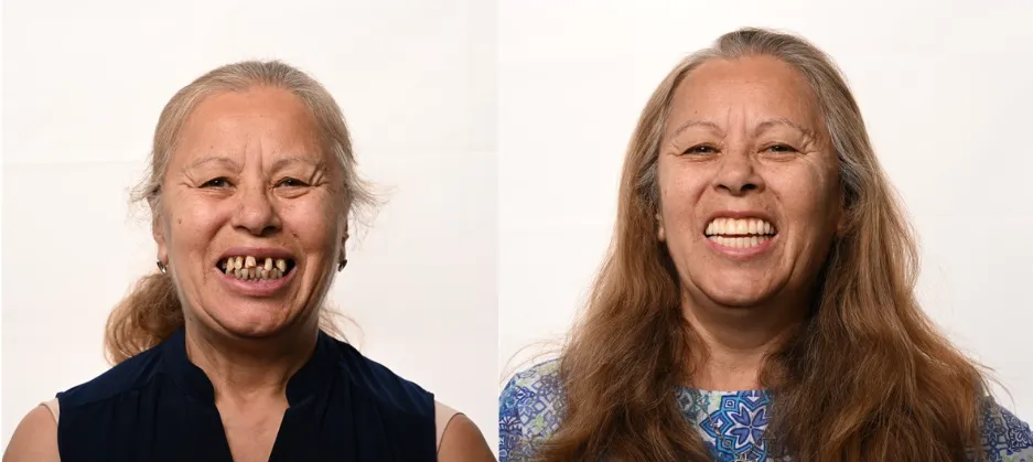 Before and after dental implant result