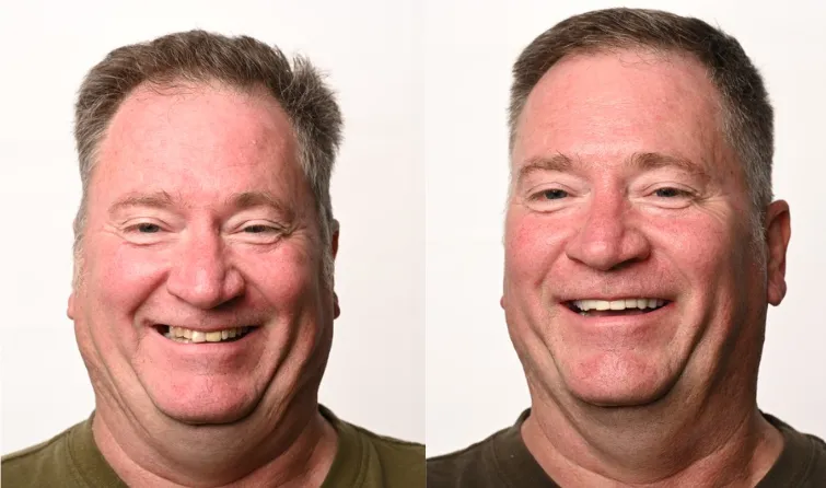 Before and after dental implant result