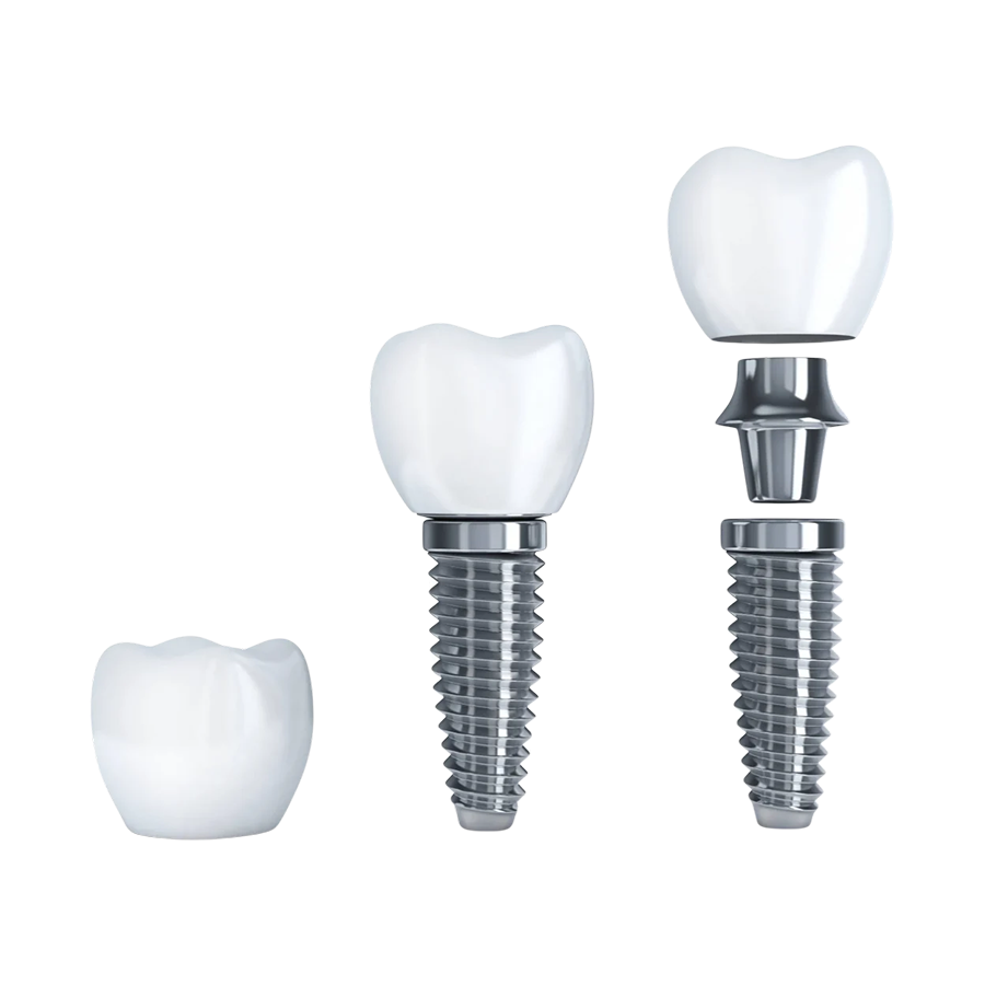 Dental implant model — titanium post, abutment and crown