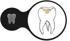 Vital tooth: the crown dot marks active circulation