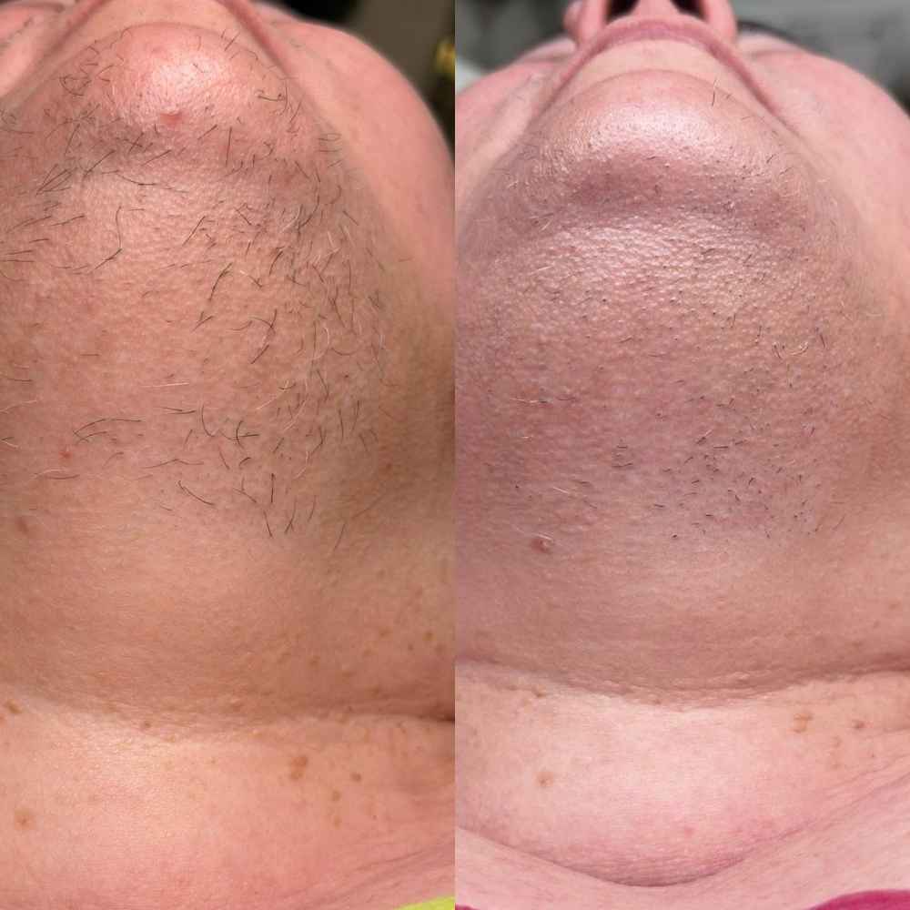 Before and after electrolysis result 1