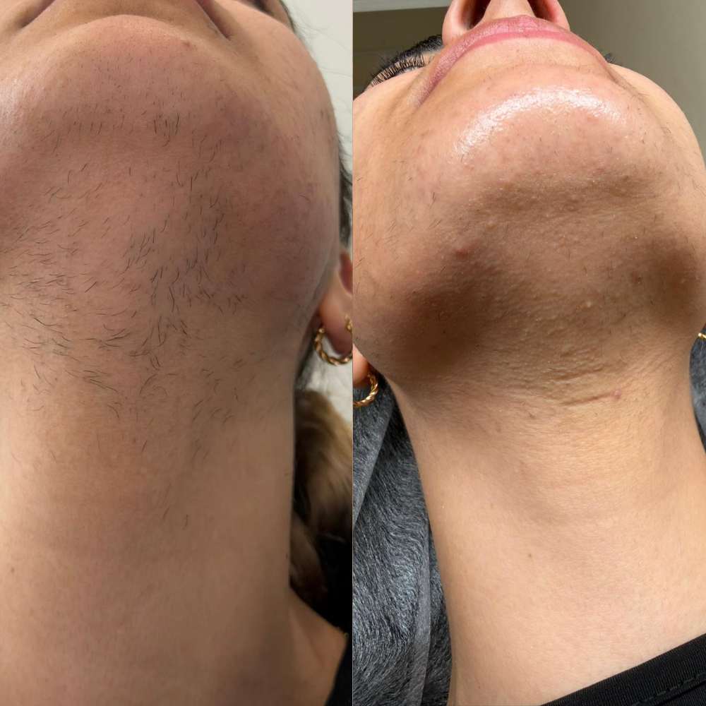 Before and after electrolysis result 2
