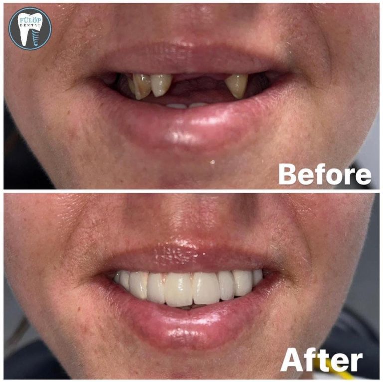 Fülöp Dentál munkánk 10
