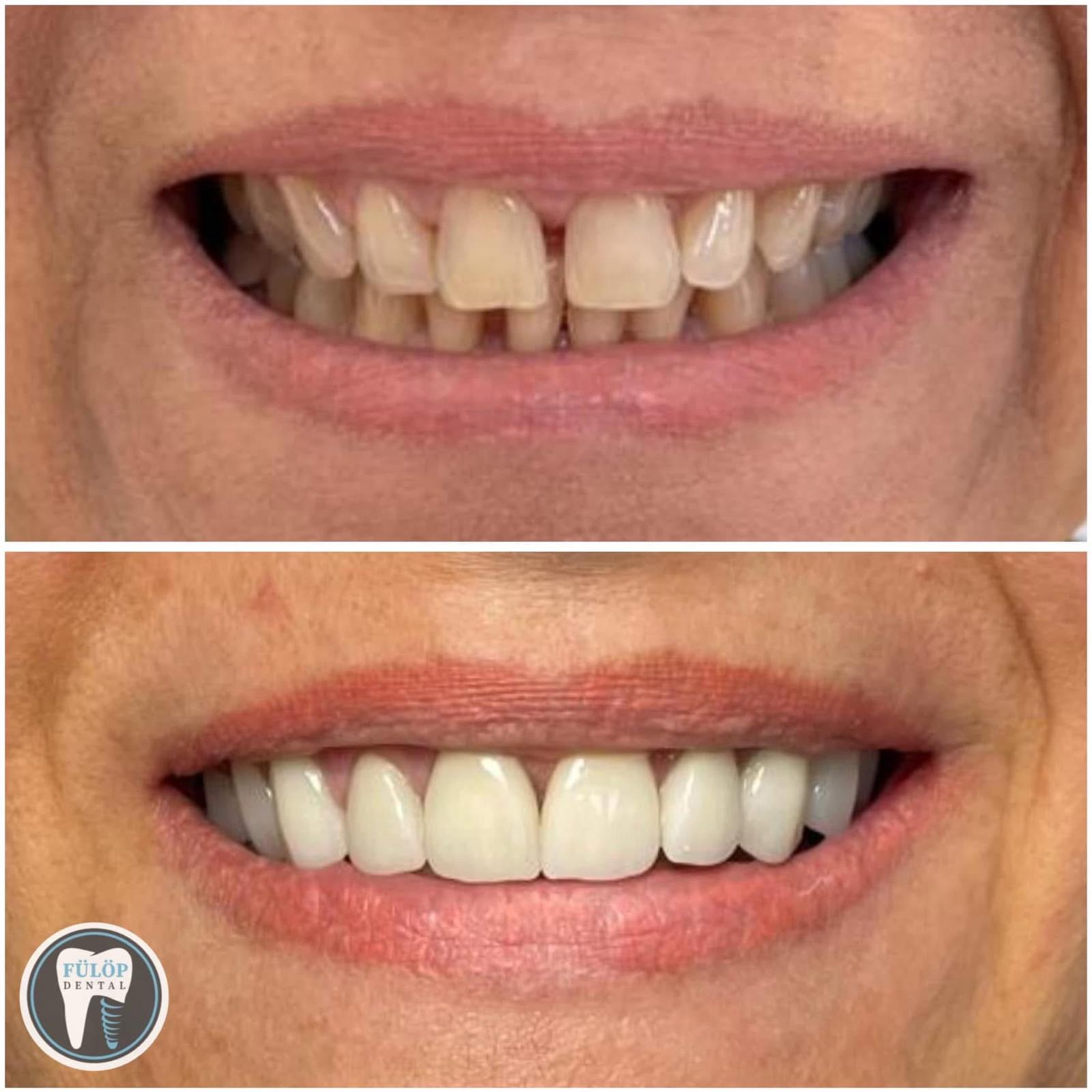 Fülöp Dentál munkánk 8