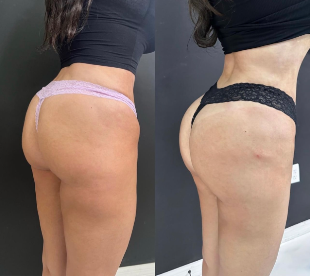 Before and After