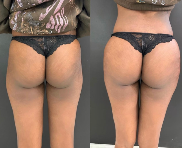 Before and After