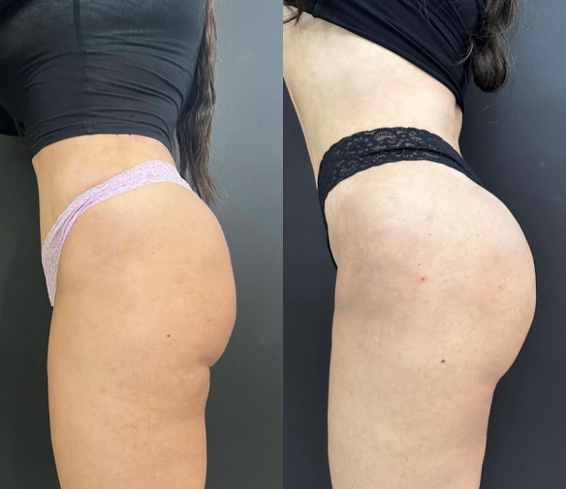 Before and After