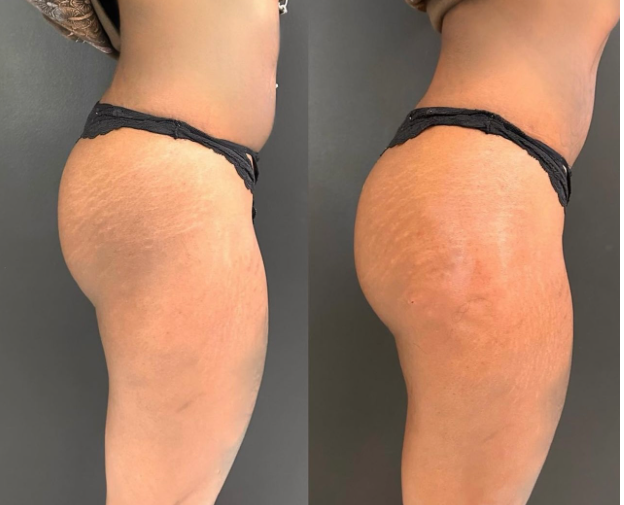 Before and After