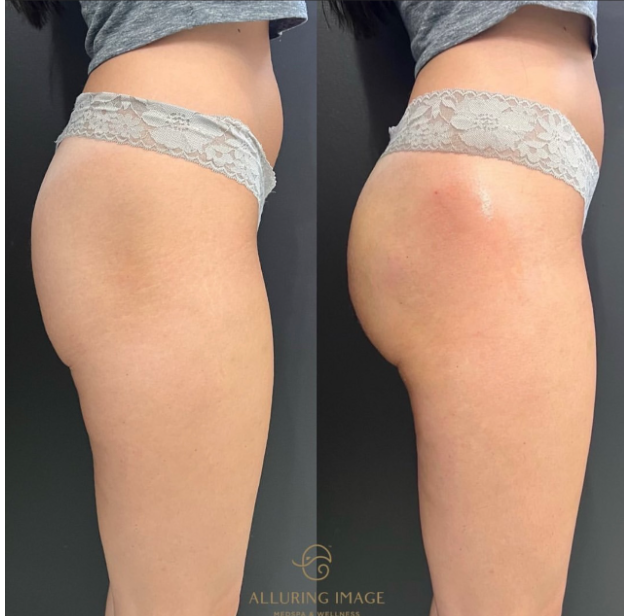 Before and After