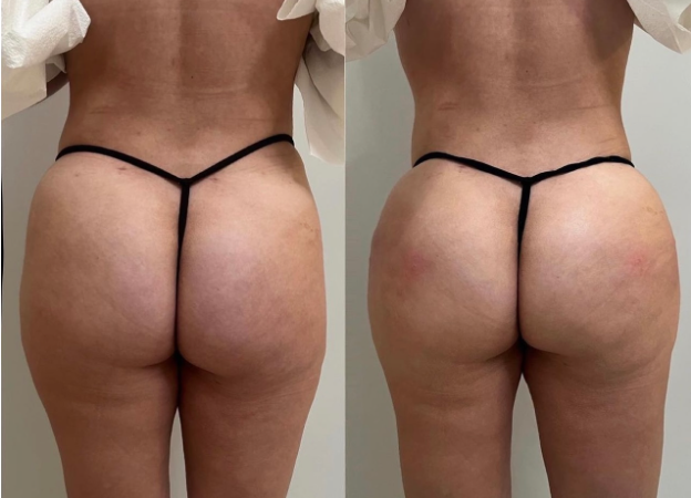 Before and After