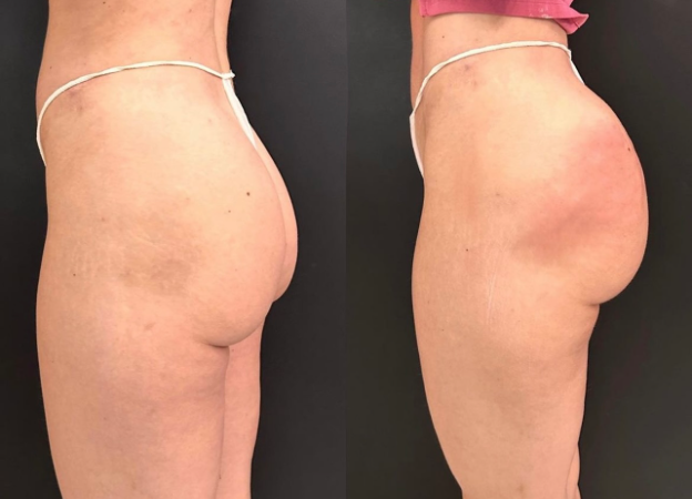 Before and After