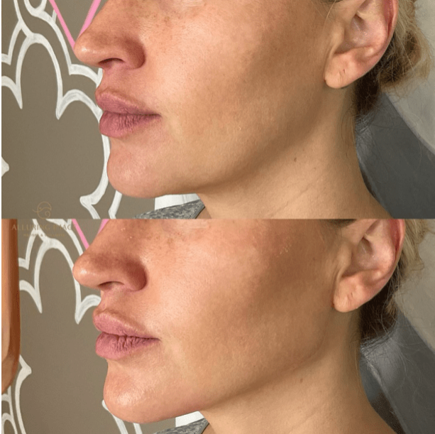 Before and After 1