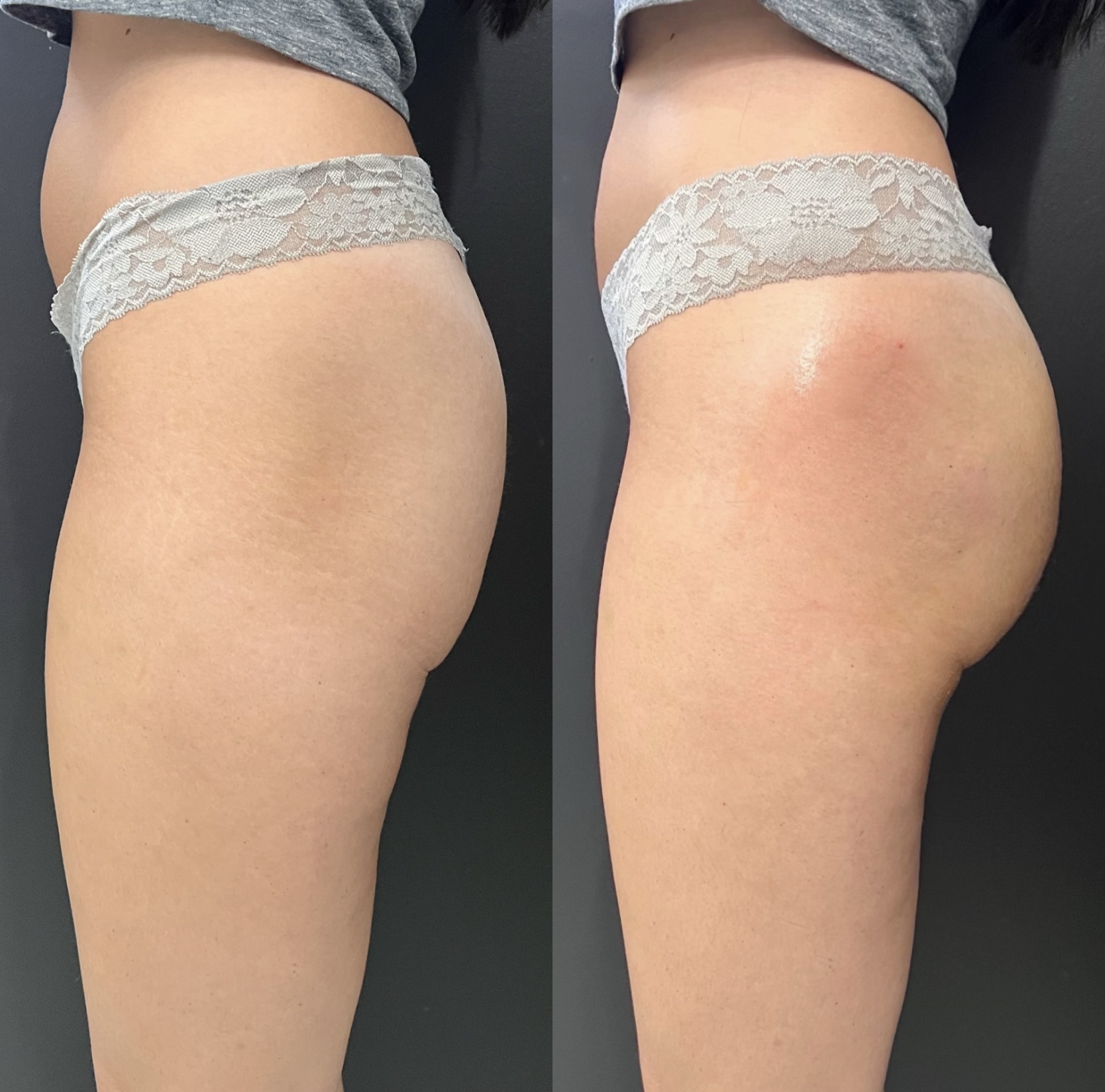 Non-Surgical BBL in Delray Beach, FL