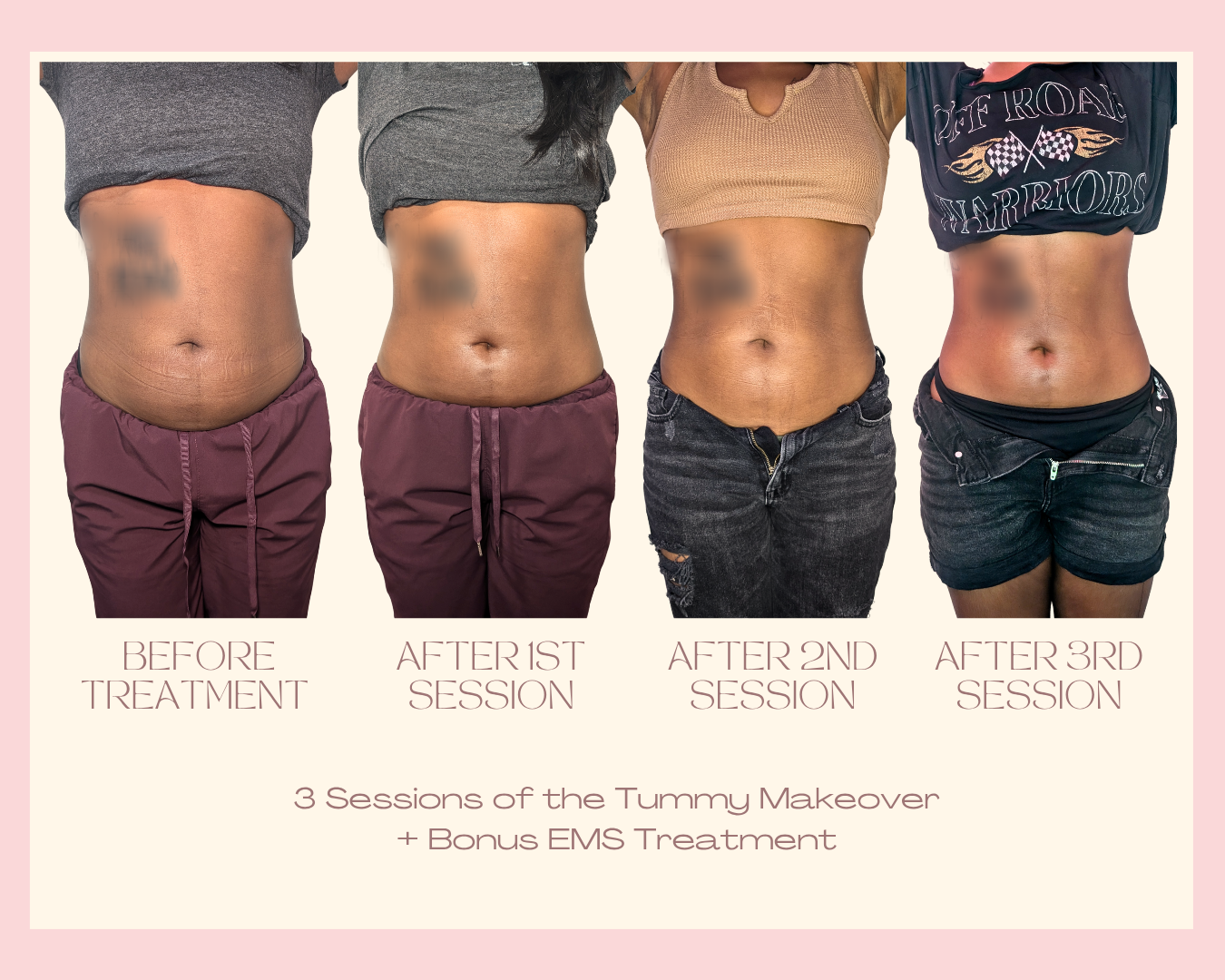 Tummy Makeover — 3 Sessions client result