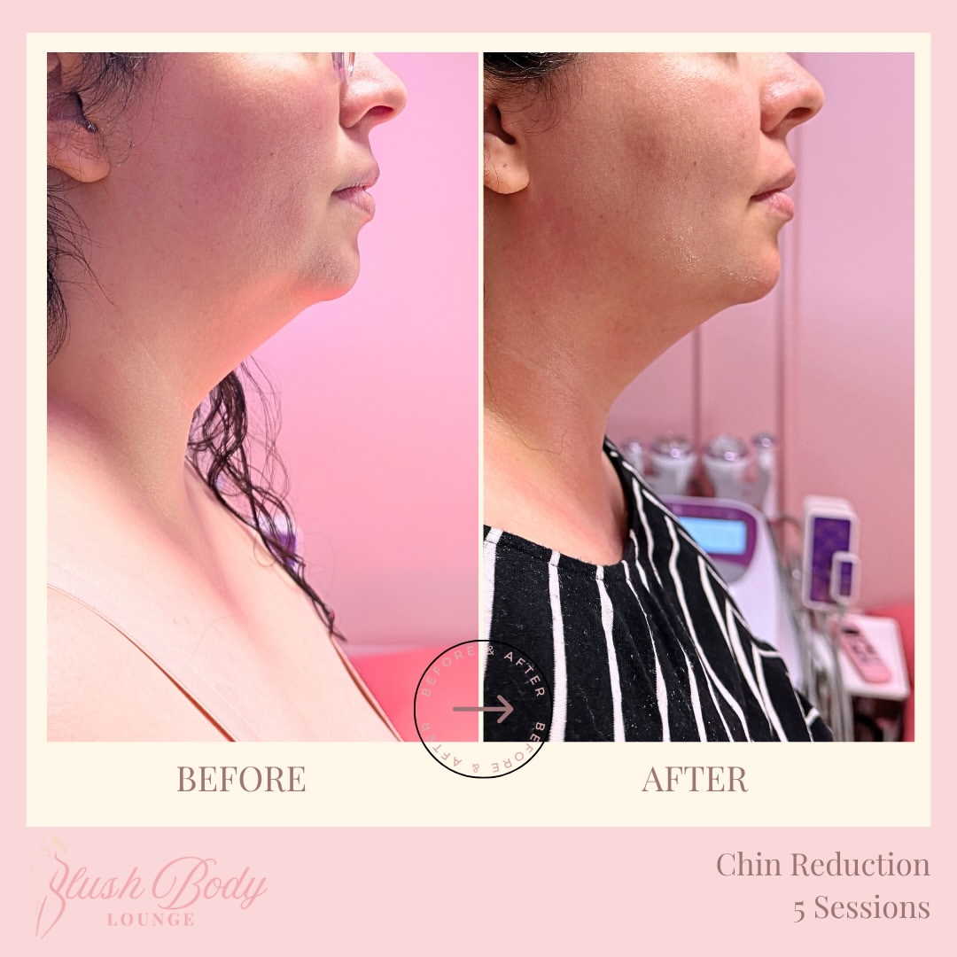 Chin Reduction — 5 Sessions client result