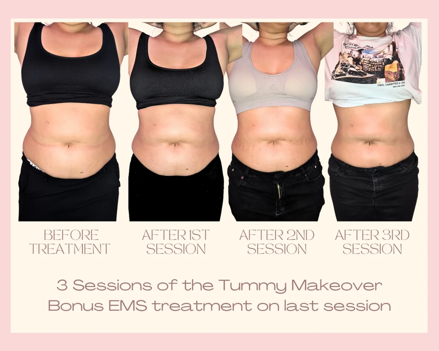 Tummy Makeover — 3 Sessions client result