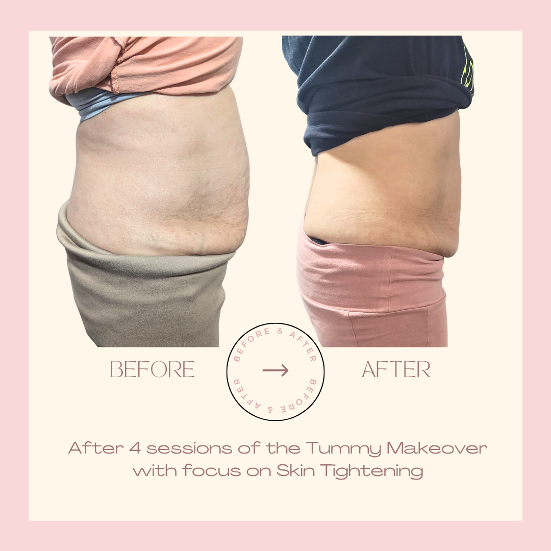 Tummy Makeover — 4 Sessions client result